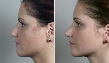 Rhinoplasty Patient 71