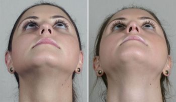 Rhinoplasty Patient 71