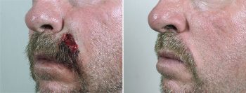 Skin Cancer Treatment Patient 55