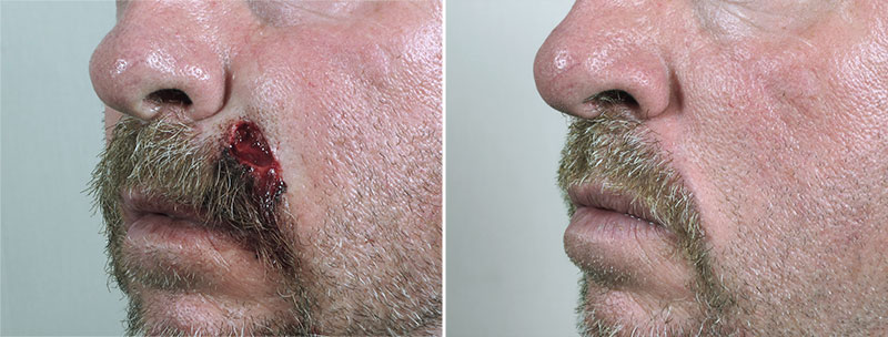 Skin Cancer Treatment Patient 55