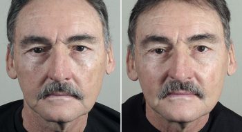 Halo & BBL Patient 6