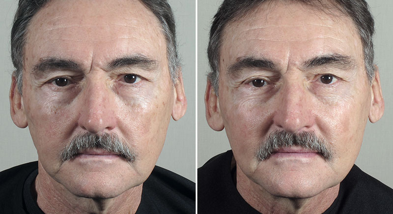 Halo & BBL Patient 6