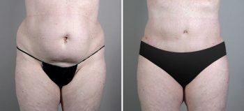 Blog Image for Dr. Parker Talks Tummy Tucks: Figuring Out a Treatment Plan for Top-Notch Results