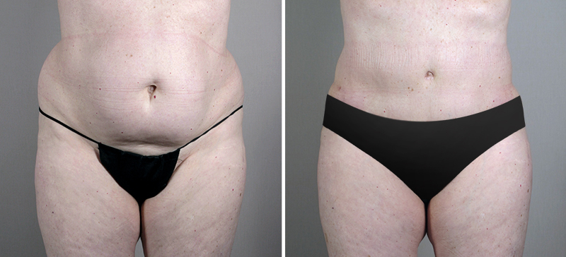tummy tuck New Jersey Image