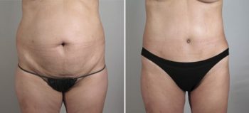 Tummy tuck before and after image