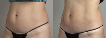 CoolSculpting Patient 05