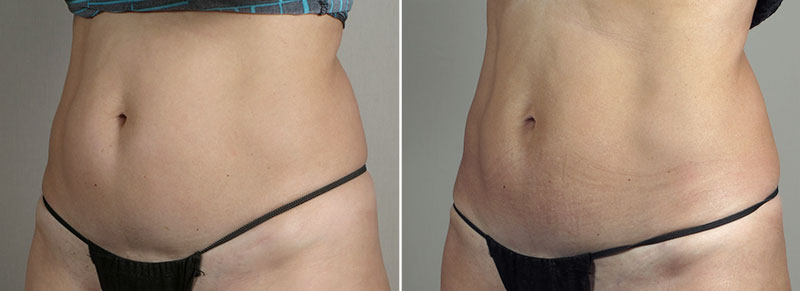 CoolSculpting Patient 05