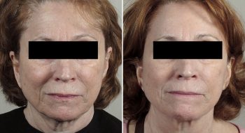 Microneedling with Ultherapy