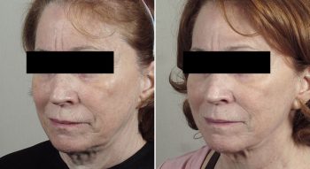 Microneedling with Ultherapy