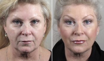 Skin Resurfacing Patient 11