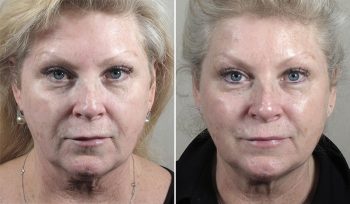 Skin Resurfacing Patient 11