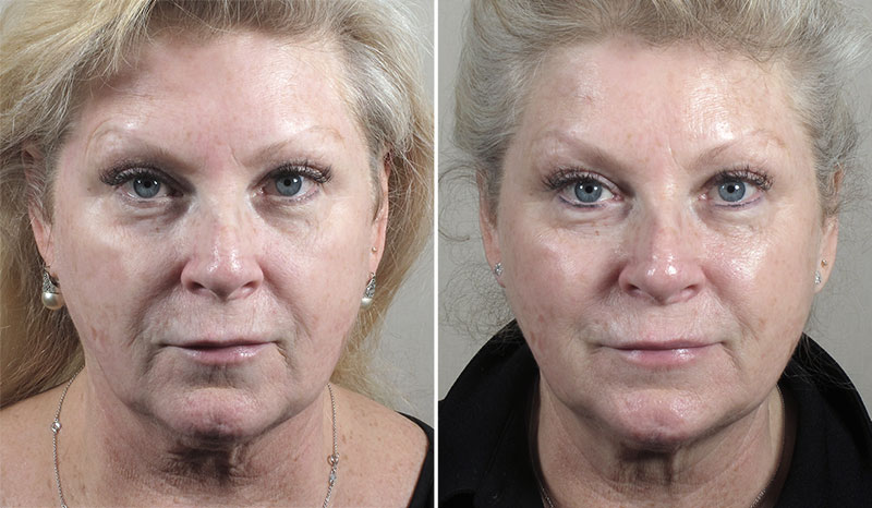 Skin Resurfacing Patient 11