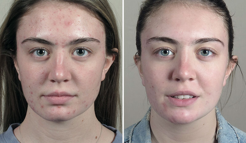 Skin Resurfacing Patient 12