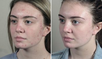 Skin Resurfacing Patient 12