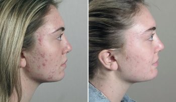 Skin Resurfacing Patient 12