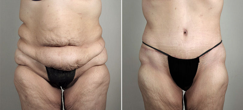 Post Bariatric Surgery Patient 5