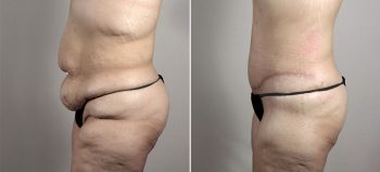 Post Bariatric Surgery Patient 5