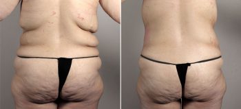 Post Bariatric Surgery Patient 5