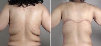 Post Bariatric Surgery Patient 5