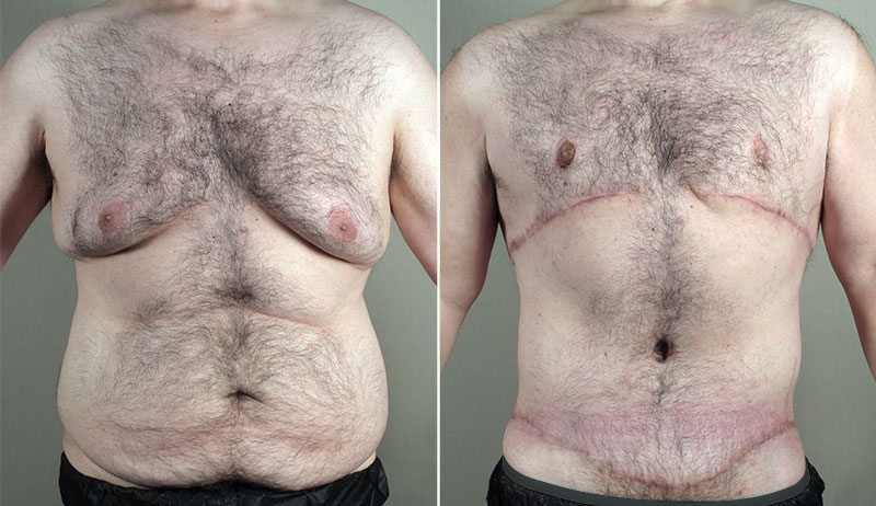 Body Lift with Gynecomastia