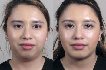 Chin Implant & Neck Liposuction 2