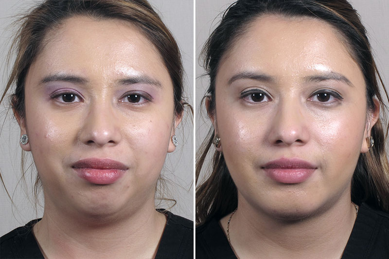 Chin Implant & Neck Liposuction 2