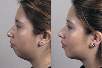 Chin Implant & Neck Liposuction 2
