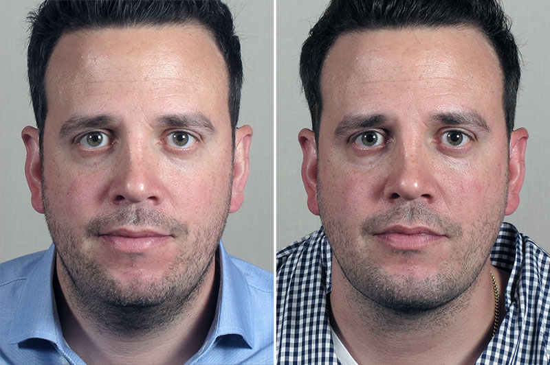 Chin Implant & Neck Liposuction 1