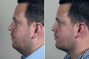 Chin Implant & Neck Liposuction 1