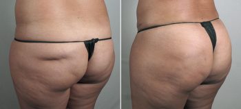 Fat Transfer to Buttocks