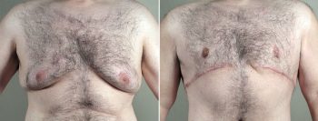Body Lift with Gynecomastia