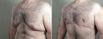 Body Lift with Gynecomastia