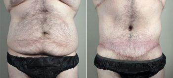 Body Lift with Gynecomastia