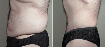 Body Lift with Gynecomastia