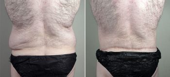 Body Lift with Gynecomastia