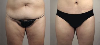 Mommy Makeover Patient 32