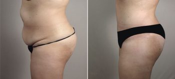 Mommy Makeover Patient 32