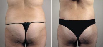 Mommy Makeover Patient 32