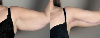 Upper Arm Rejuvenation Patient 14 – Arm Lift