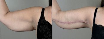 Upper Arm Rejuvenation Patient 14 – Arm Lift