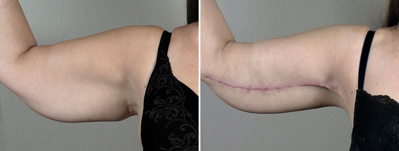 Upper Arm Rejuvenation Patient 14 – Arm Lift