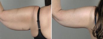 Upper Arm Rejuvenation Patient 14 – Arm Lift