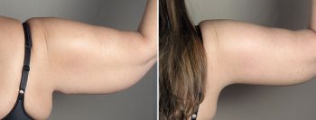 Upper Arm Rejuvenation Patient 14 – Arm Lift