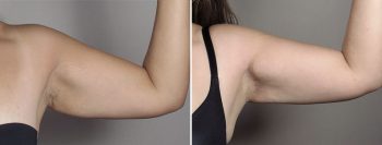 Mommy Makeover Patient 32