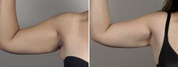 Mommy Makeover Patient 32