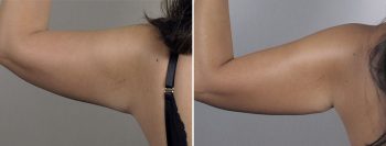 Mommy Makeover Patient 32