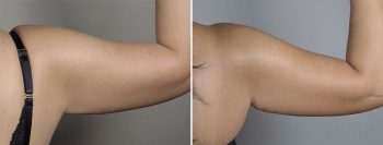 Mommy Makeover Patient 32