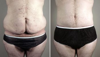 Body Lift and Tummy Tuck