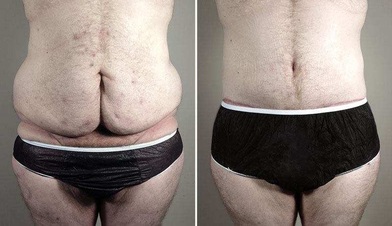 Body Lift and Tummy Tuck