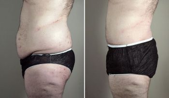 Body Lift and Tummy Tuck